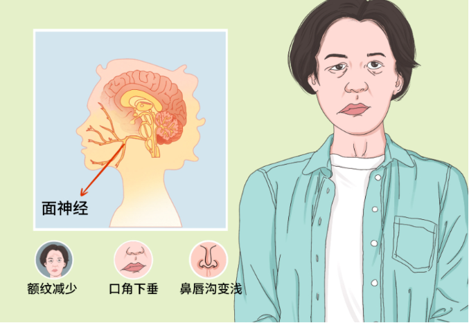 面神经疾病如何精确诊断?